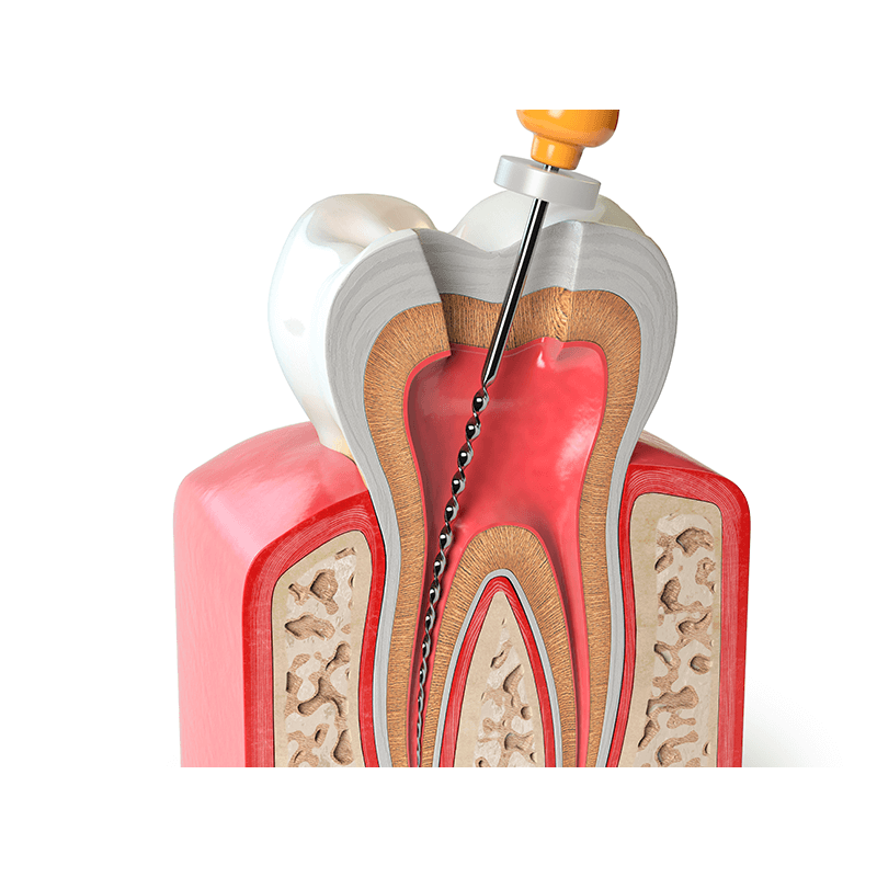 TRATAMENTO ENDODONTICO