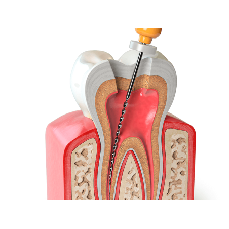 TRATAMENTO ENDODONTICO