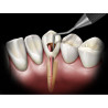 ENDODONTIA